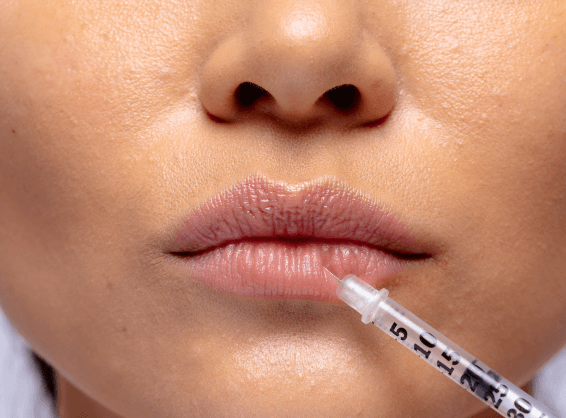Qway Medspa Fillers Treatment