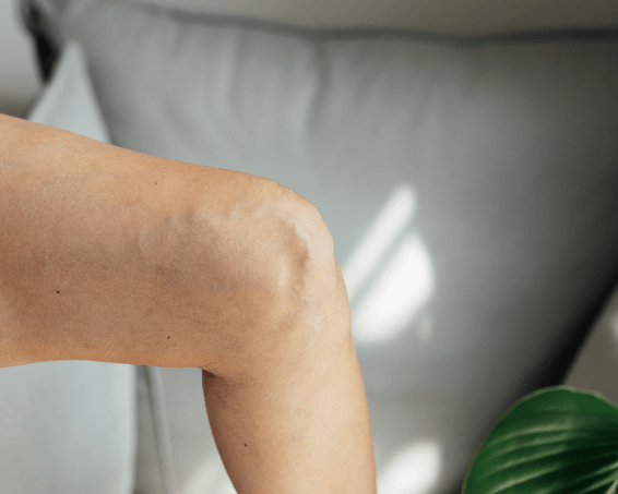 Max Vasculaze treatment for visible veins on a patient’s leg.