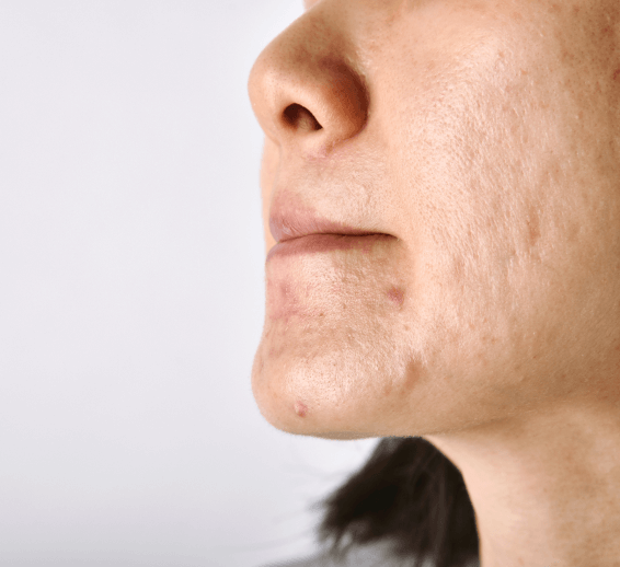 Morpheus8 facial treatment in progress at a medspa.